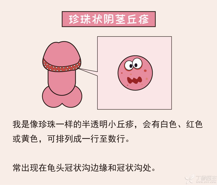 阴茎珍珠状丘疹