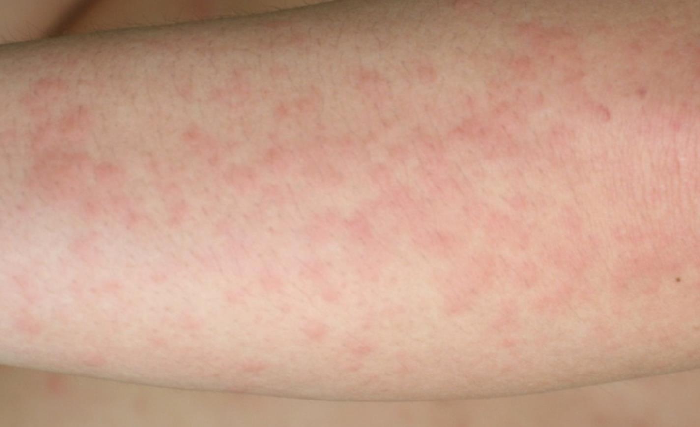 胆碱能性荨麻疹:较大的突起(风团) 图片来源:clinical