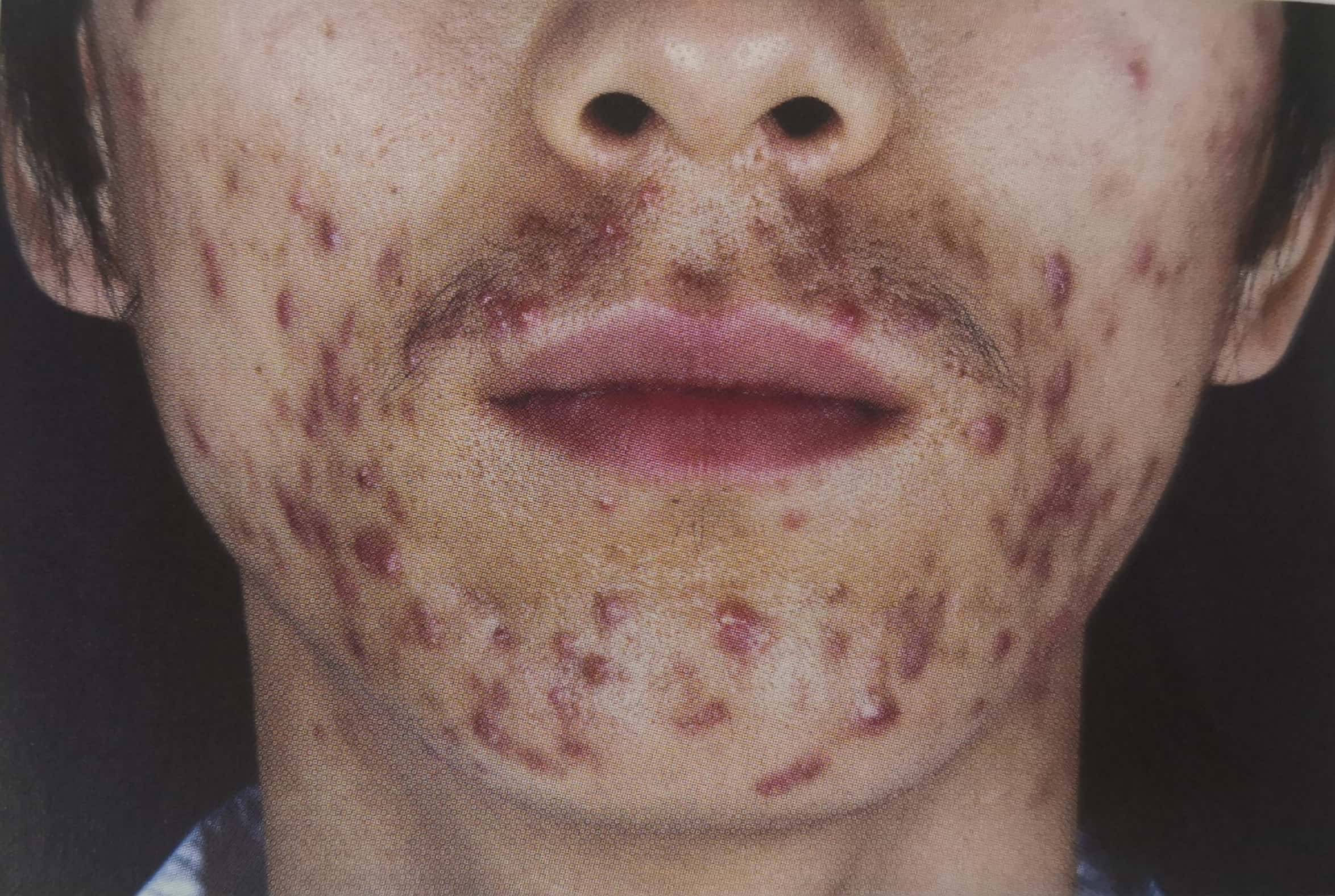 两颊,口周,下巴可见暗红色丘疹,部分丘疹顶端有脓疱