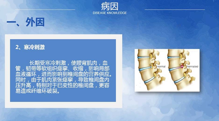 国康健康保险谈腰椎间盘突出