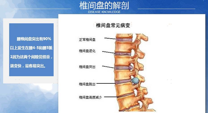 国康健康保险谈腰椎间盘突出