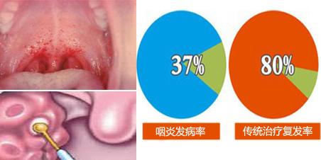 慢性咽炎——你要这样消灭喉咙里的这把“虚火” 第5张