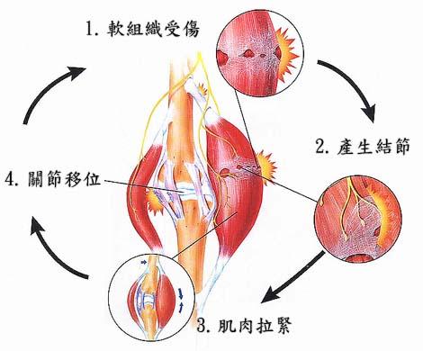 肌肉拉伤是该热敷还是，冷敷？看完你就知道了