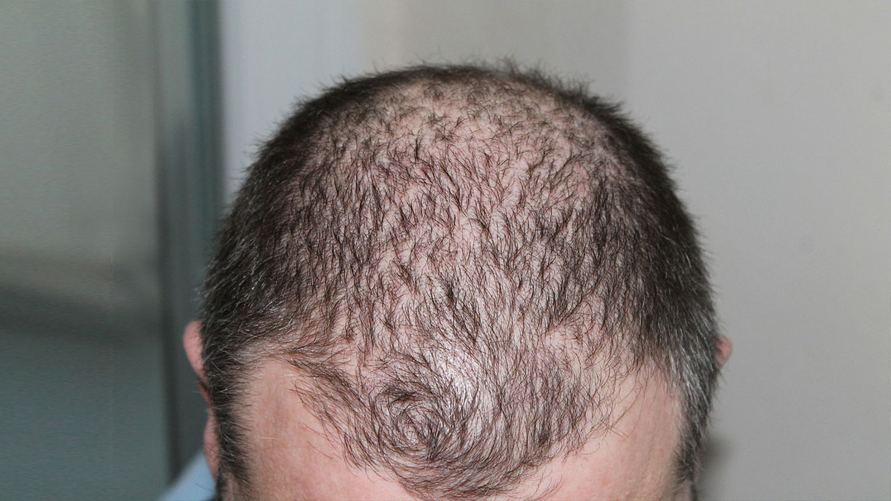 雄激素性脱发症状_病因_治疗方法_鉴别_专家咨询_疾病百科_国康健康