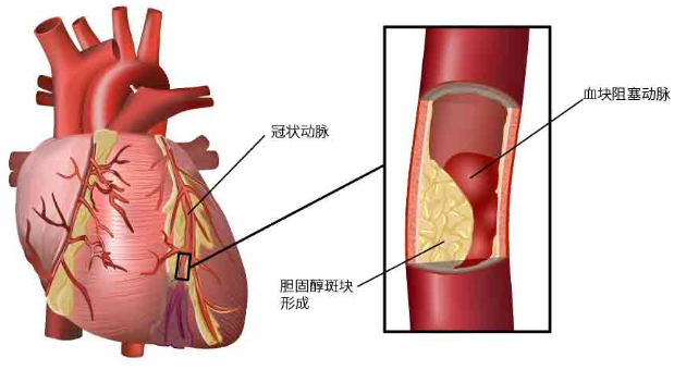 心梗的“八个危险因素”，“七个一”远离心梗！