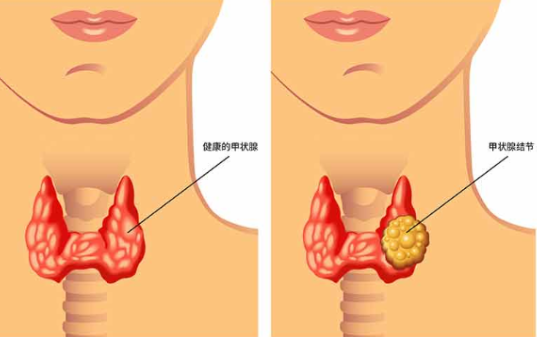 关于甲状腺结节的那些事，原来饮食也有那么多讲究