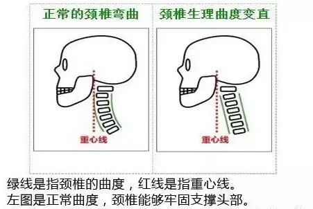 颈椎病之殇——颈椎生理曲度变直 第0张