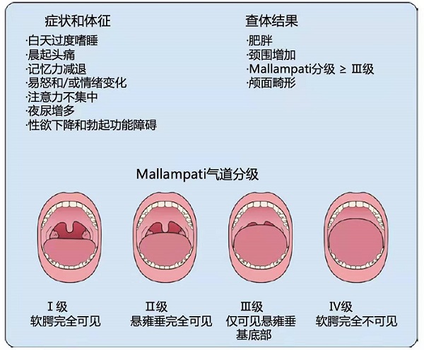 打鼾真的会诱发心血管疾病吗？