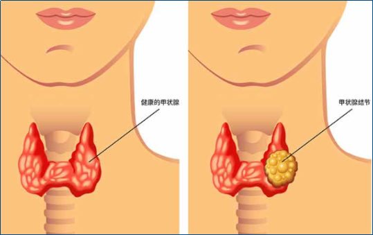 体检查出甲状腺结节应该怎么办？不复查真的会癌变吗？一文讲清楚