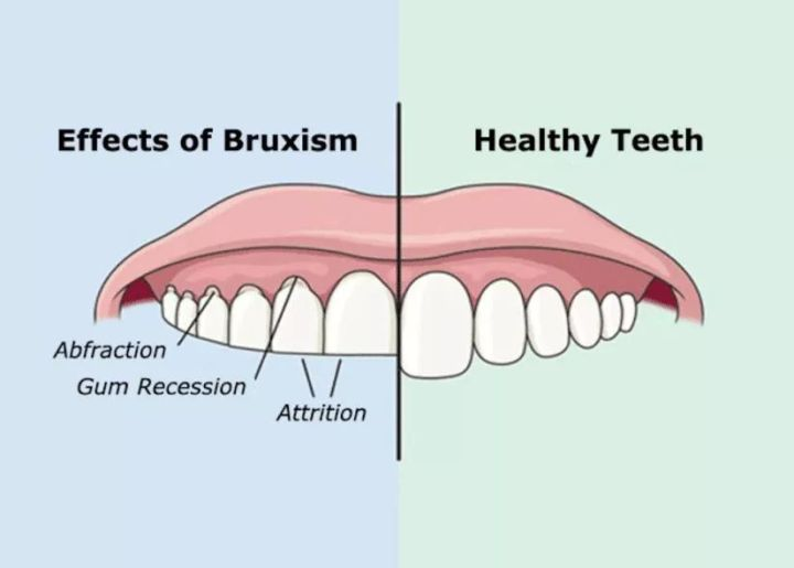 睡觉时磨牙，要不要紧？