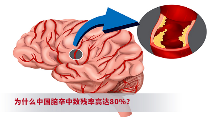 为什么中国脑卒中致残率高达80%？