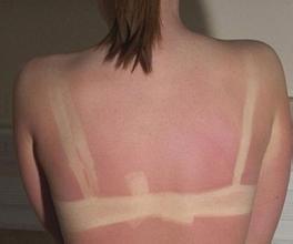 夏日炎炎，如何应对日光性皮炎？