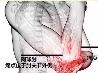 从不打网球的人，为什么也会得网球肘？这就是原因！