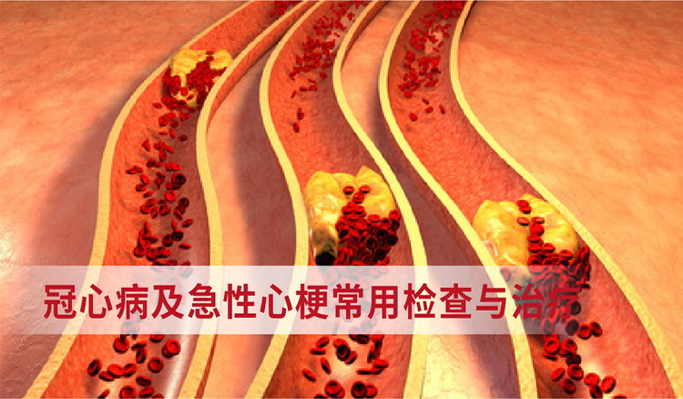 冠心病及急性心梗常用检查与治疗