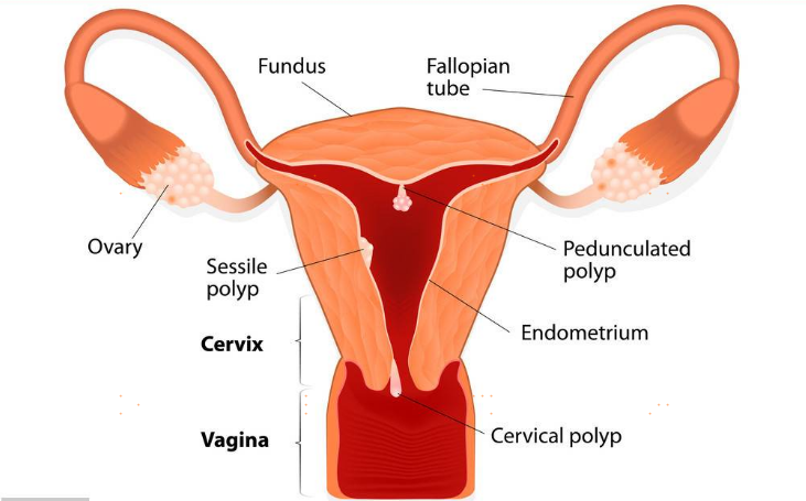 “子宫长息肉”怎么破？