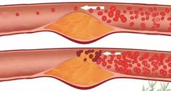 健康保险之血管堵塞症状