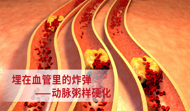 埋在血管里的炸弹--动脉粥样硬化