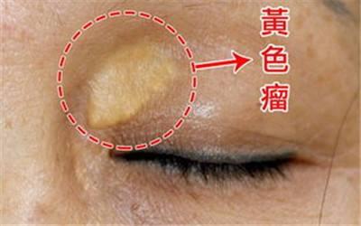 不体检也能看出血脂异常？告诉你三种判断血脂异常的征兆