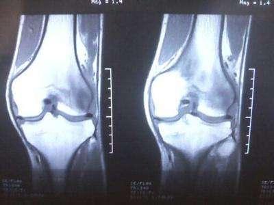 步行过度，容易膝盖受损！这些细节你一定要注意！