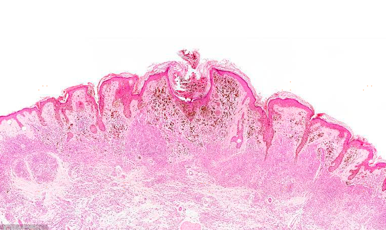 你知道哪种癌症的死亡率最高吗？来看看肿瘤专科医生这样说