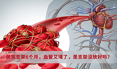 做完支架6个月，血管又堵了，是支架没放好吗？